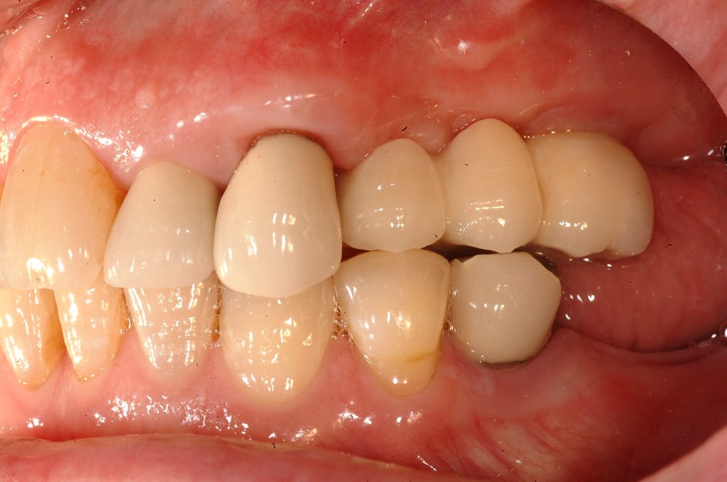 sinus augmentation after