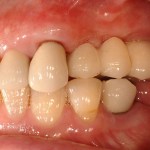 sinus augmentation after