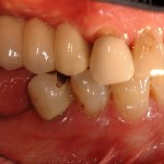 sinus augmentation before