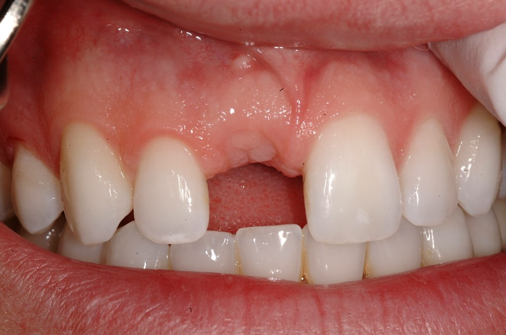 dental implant before