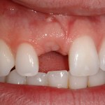 dental implant before