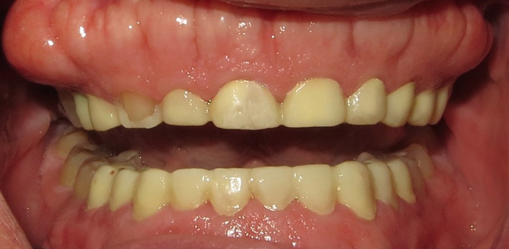 crown lengthening before