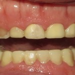 crown lengthening before