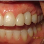 gum augmentation before