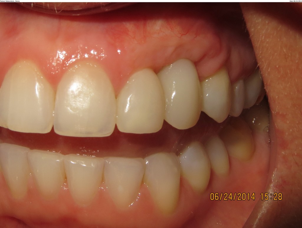 gum augmentation before
