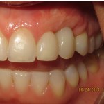 gum augmentation before