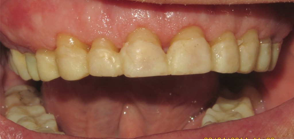 crown lengthening before