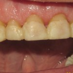 crown lengthening before