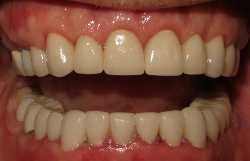 crown lengthening after