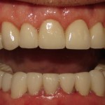 crown lengthening after