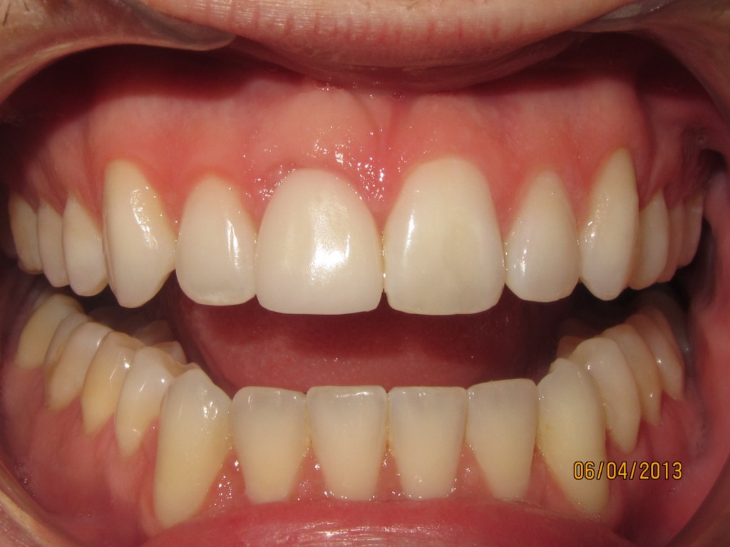 dental implant after