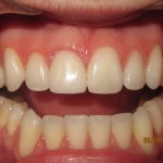 dental implant after