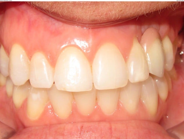 gum augmentation before