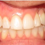 gum augmentation before