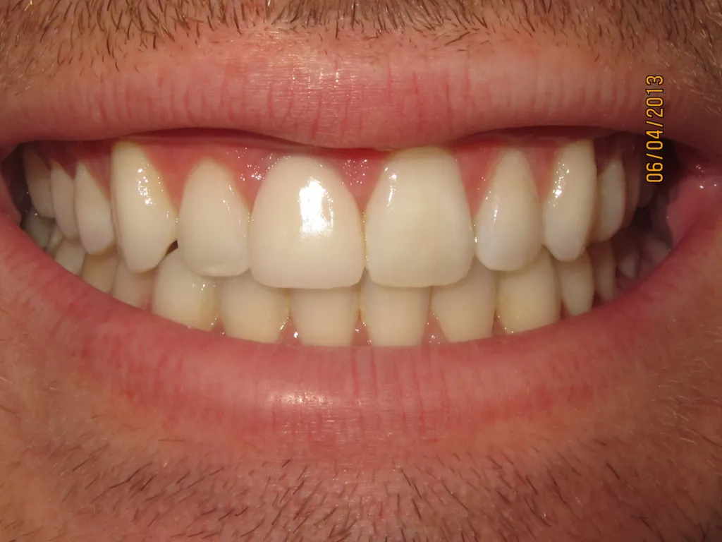 dental implant after=
