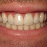 dental implant after=