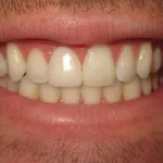 dental implant after=
