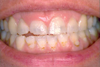 Crown Lengthening,Charles F. Orth, DDS, PA