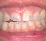 Crown Lengthening,Charles F. Orth, DDS, PA