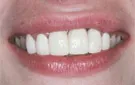 Crown Lengthening,Charles F. Orth, DDS, PA