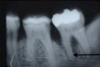 Periodontal Regeneration, Charles F. Orth, DDS, PA