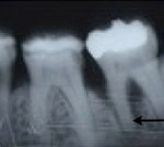 Periodontal Regeneration, Charles F. Orth, DDS, PA