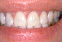 Crown Lengthening,Charles F. Orth, DDS, PA