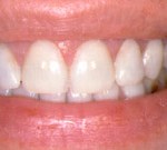 Crown Lengthening,Charles F. Orth, DDS, PA