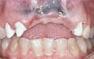 Crown Lengthening,Charles F. Orth, DDS, PA