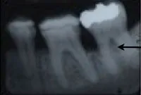 Periodontal Regeneration, Charles F. Orth, DDS, PA