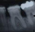Periodontal Regeneration, Charles F. Orth, DDS, PA