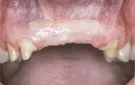 Crown Lengthening,Charles F. Orth, DDS, PA