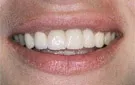 Crown Lengthening,Charles F. Orth, DDS, PA