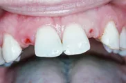 Dental Impants, Charles F. Orth, DDS, PA