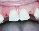 Dental Impants, Charles F. Orth, DDS, PA