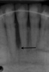 Periodontal Regeneration, Charles F. Orth, DDS, PA
