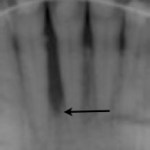 Periodontal Regeneration, Charles F. Orth, DDS, PA