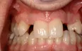 Bone grafting ,Charles F. Orth, DDS, PA