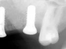 sinus augmentation before