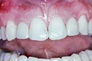 Dental Impants, Charles F. Orth, DDS, PA