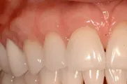 Periodontal Regeneration, Charles F. Orth, DDS, PA