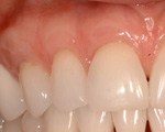 Periodontal Regeneration, Charles F. Orth, DDS, PA