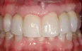 Bone grafting 2,Charles F. Orth, DDS, PA