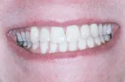 Dental Impants, Charles F. Orth, DDS, PA
