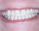 Dental Impants, Charles F. Orth, DDS, PA