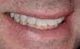 Bone grafting 3,Charles F. Orth, DDS, PA