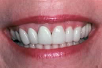 Crown Lengthening,Charles F. Orth, DDS, PA