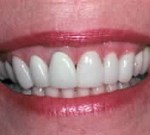 Crown Lengthening,Charles F. Orth, DDS, PA