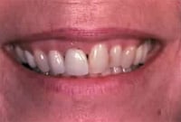 Crown Lengthening,Charles F. Orth, DDS, PA