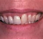 Crown Lengthening,Charles F. Orth, DDS, PA